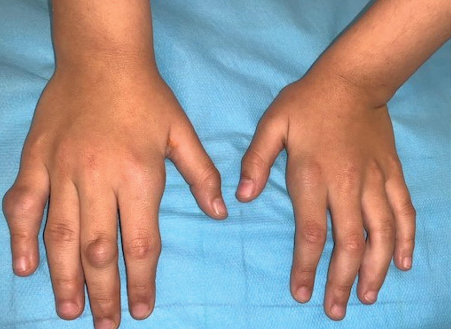 Hypercholesterolemia